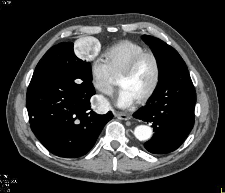 Metastatic Renal Cell Carcinoma to Pancreas and Mediastinum - CTisus CT Scan