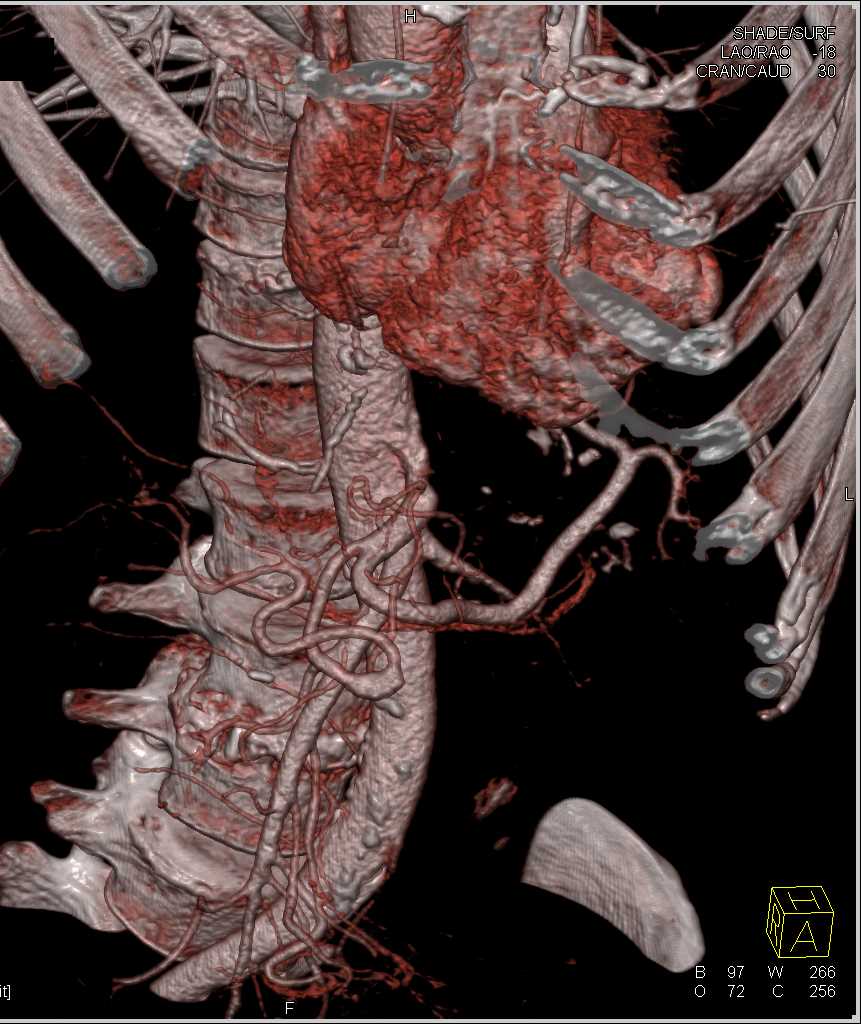 Polycystic Renal Disease with Complex Cyst Upper Pole Left Kidney - CTisus CT Scan