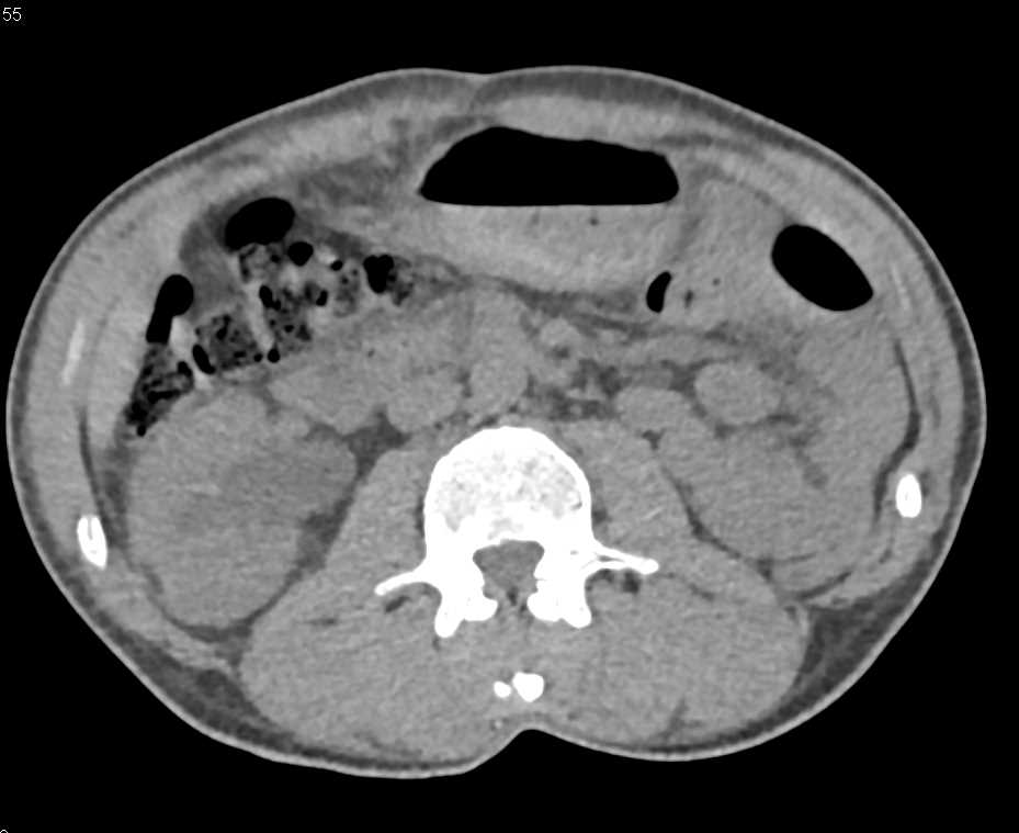 Failing Right Kidney - CTisus CT Scan