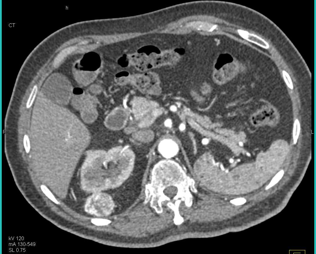 Metastatic Renal Cell Carcinoma to the Pancreas and Perirenal Space - CTisus CT Scan