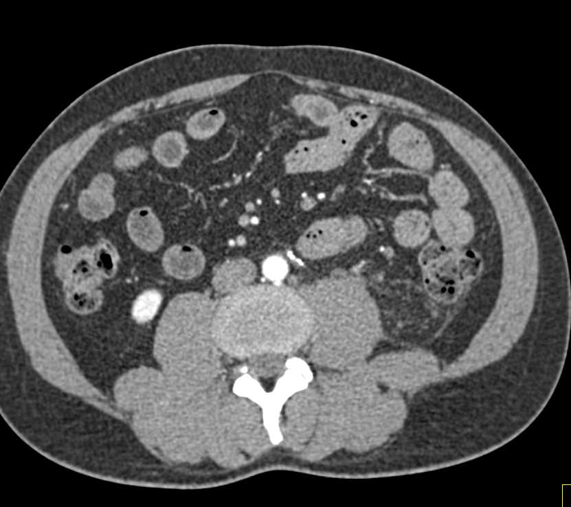 Left Hydronephrosis and Delayed Function Left Kidney - CTisus CT Scan