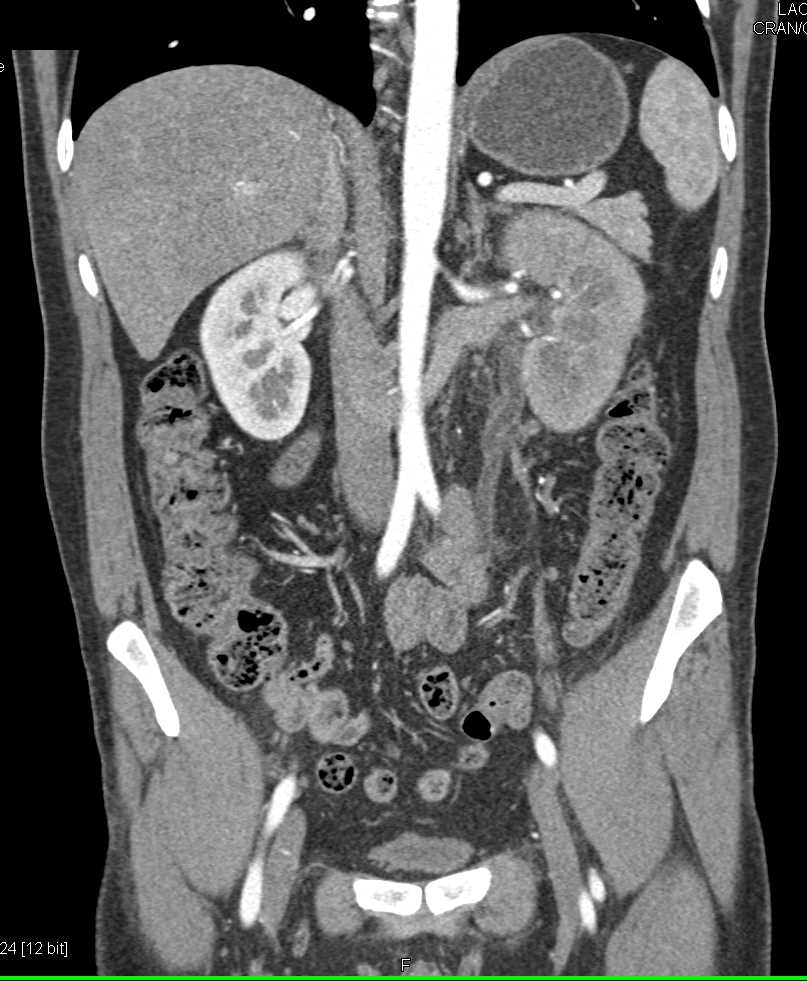 Left Hydronephrosis and Delayed Function Left Kidney - CTisus CT Scan