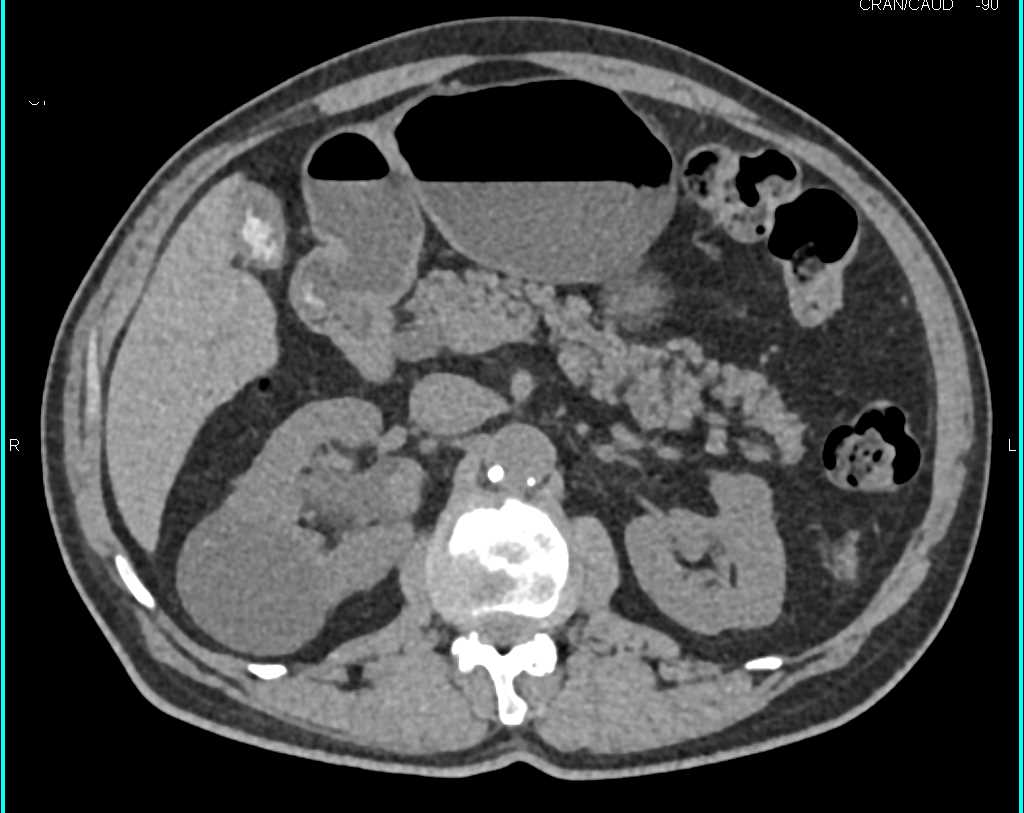 Transitional Cell Carcinoma Right Renal Pelvis - CTisus CT Scan