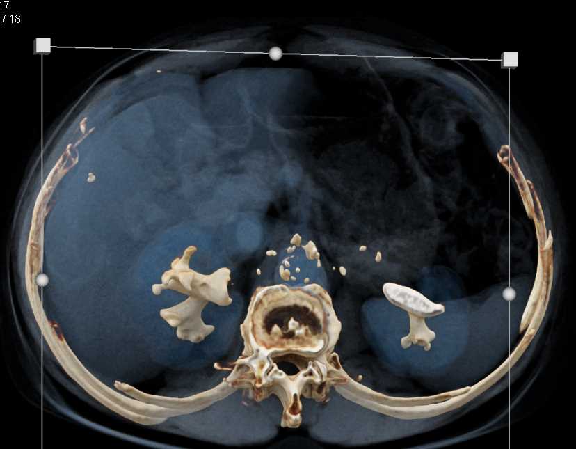 Transitional Cell Carcinoma Right Renal Pelvis with Cinematic Rendering - CTisus CT Scan