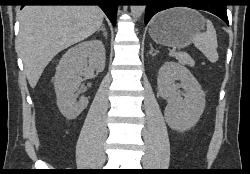 Papillary Necrosis Bilaterally - CTisus CT Scan