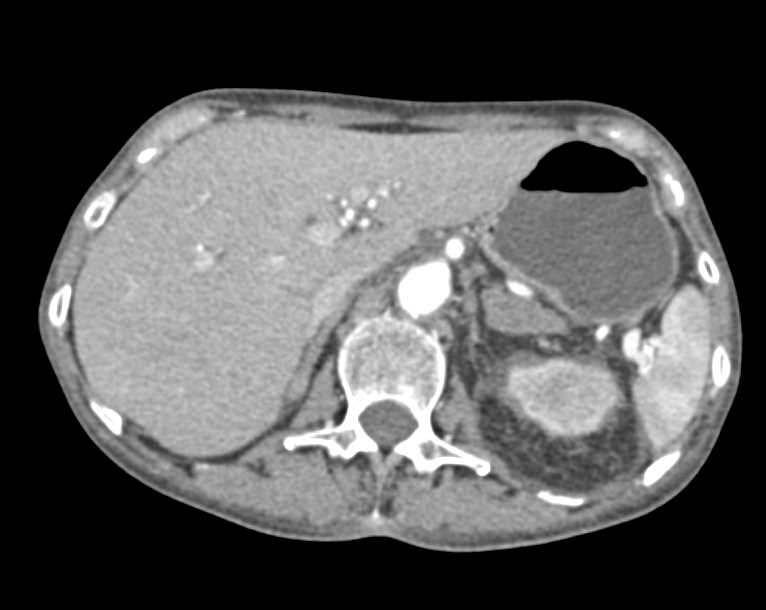 Pyelonephritis with Nephrostomy Tube in Place - CTisus CT Scan