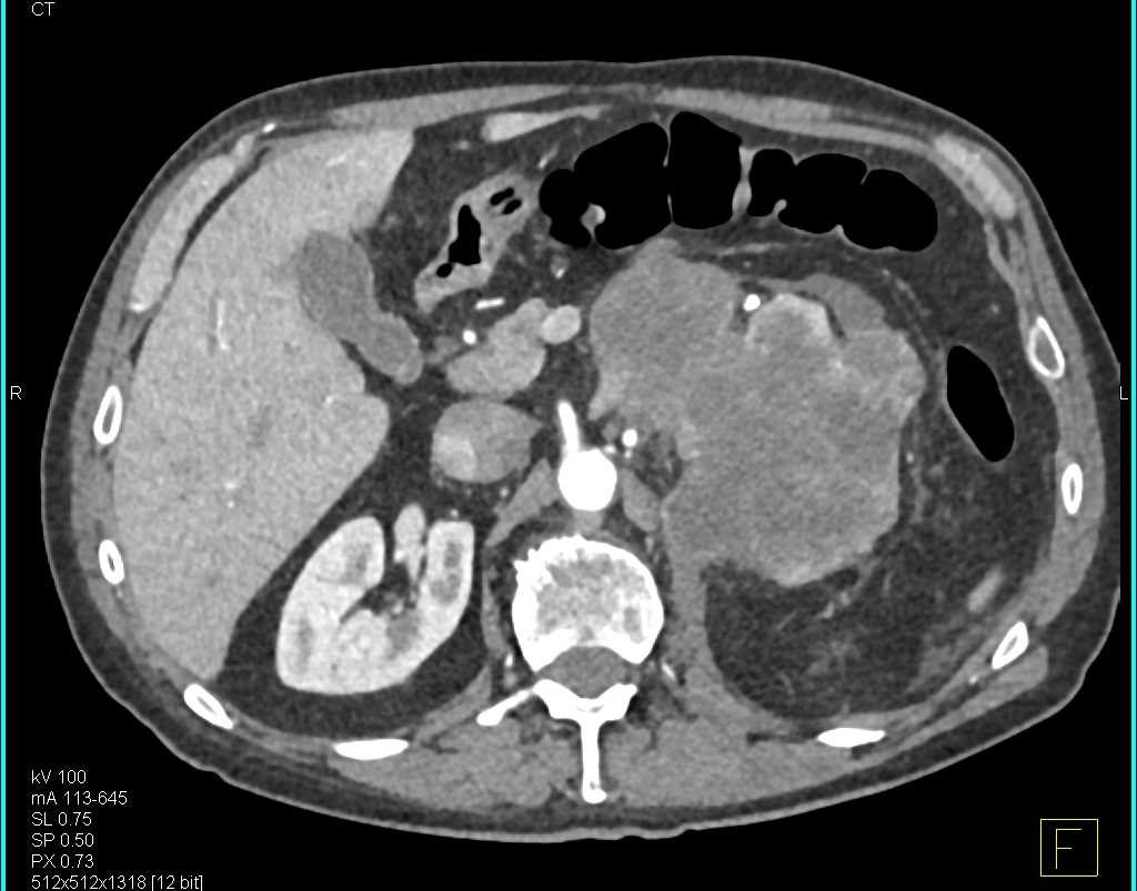 Retroperitoneal Sarcoma Displaces the Left Kidney - CTisus CT Scan