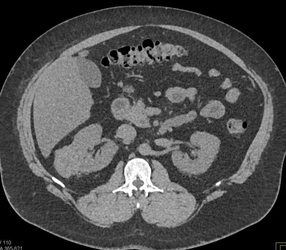 Papillary Renal Cell Carcinoma Right Kidney - CTisus CT Scan