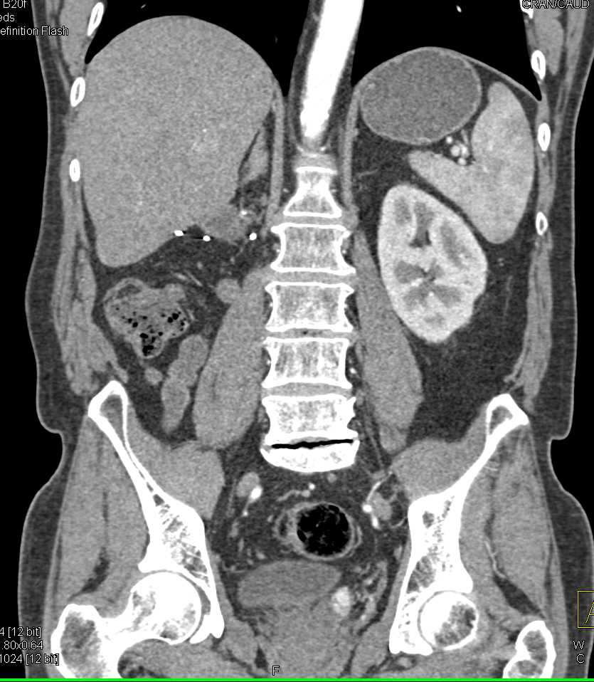 Renal Cell Carcinoma Metastatic to the Left Seminal Vesicle - CTisus CT Scan