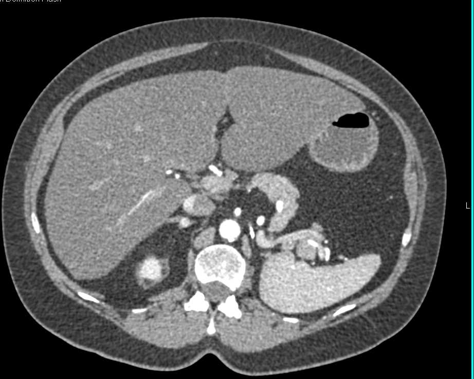 Classic Post Left Nephrectomy Anatomy - CTisus CT Scan