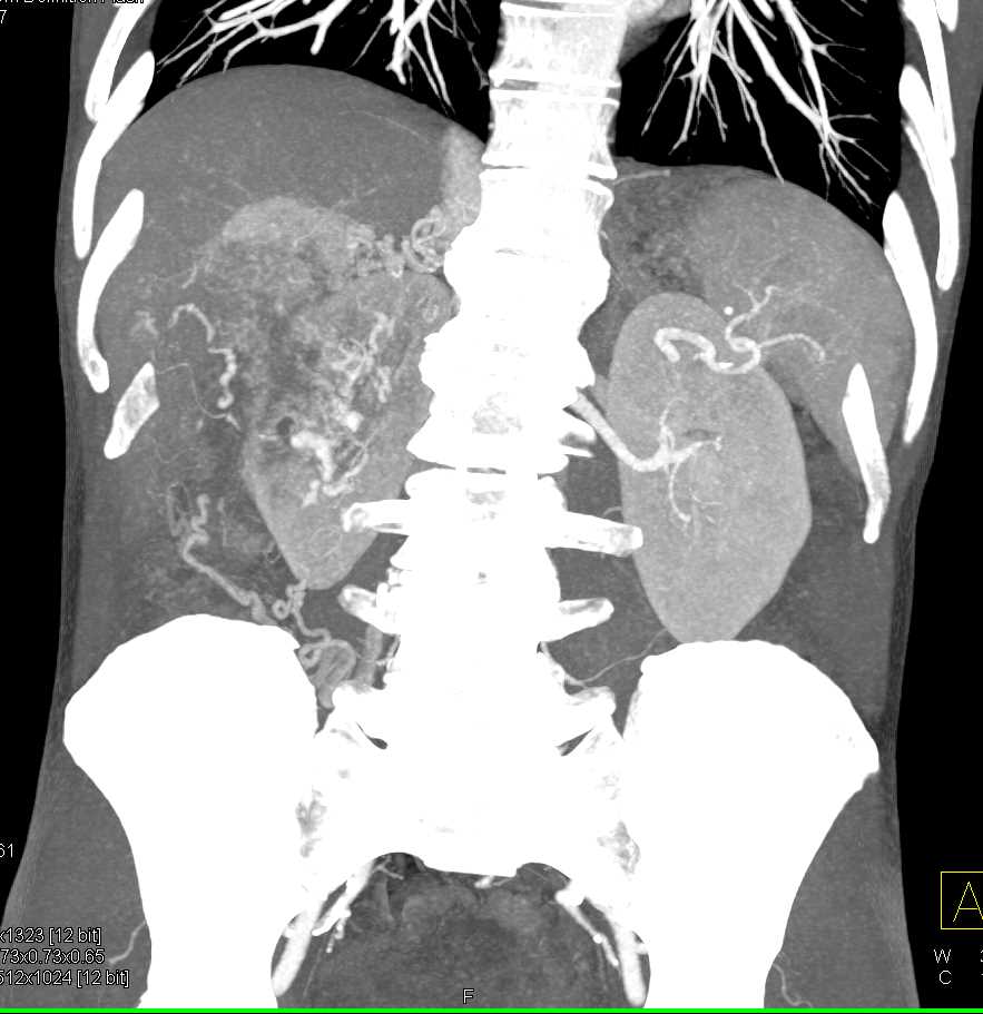 Renal Cell Carcinoma - CTisus CT Scan