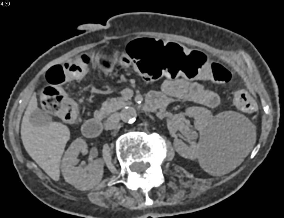 Transitional Cell Carcinoma Left Kidney - CTisus CT Scan