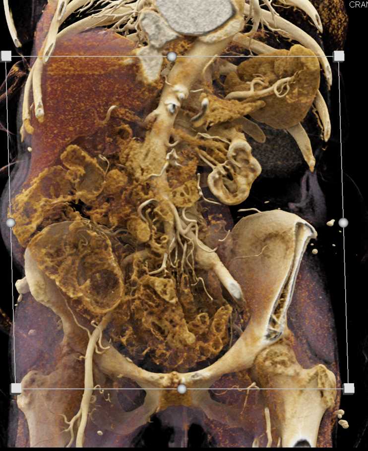 Transitional Cell Carcinoma Left Kidney - CTisus CT Scan