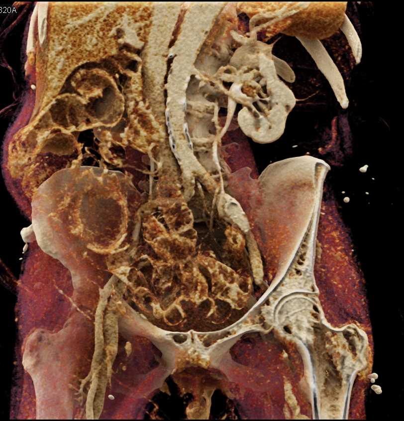 Transitional Cell Carcinoma Left Kidney - CTisus CT Scan