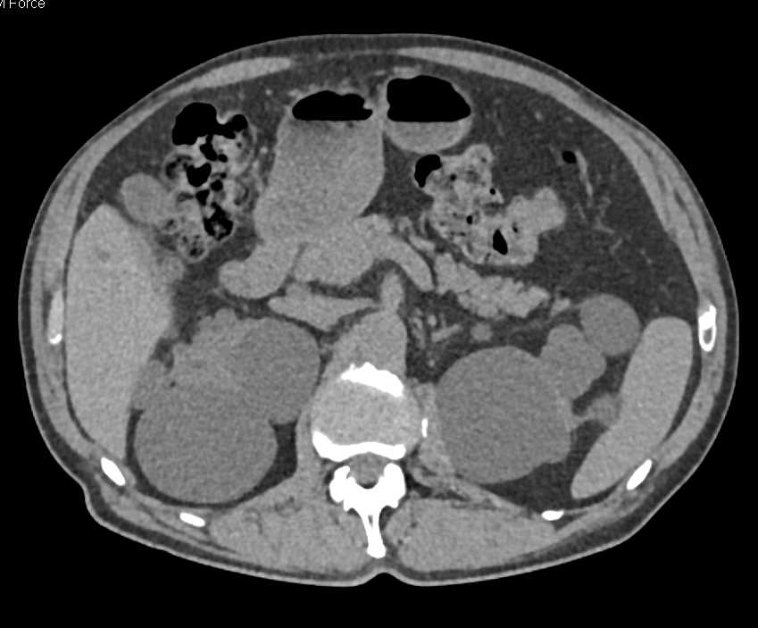 Polycystic Kidney Disease - CTisus CT Scan