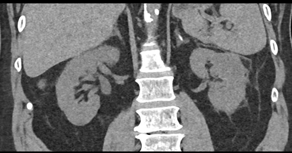 Renal Abscess - CTisus CT Scan