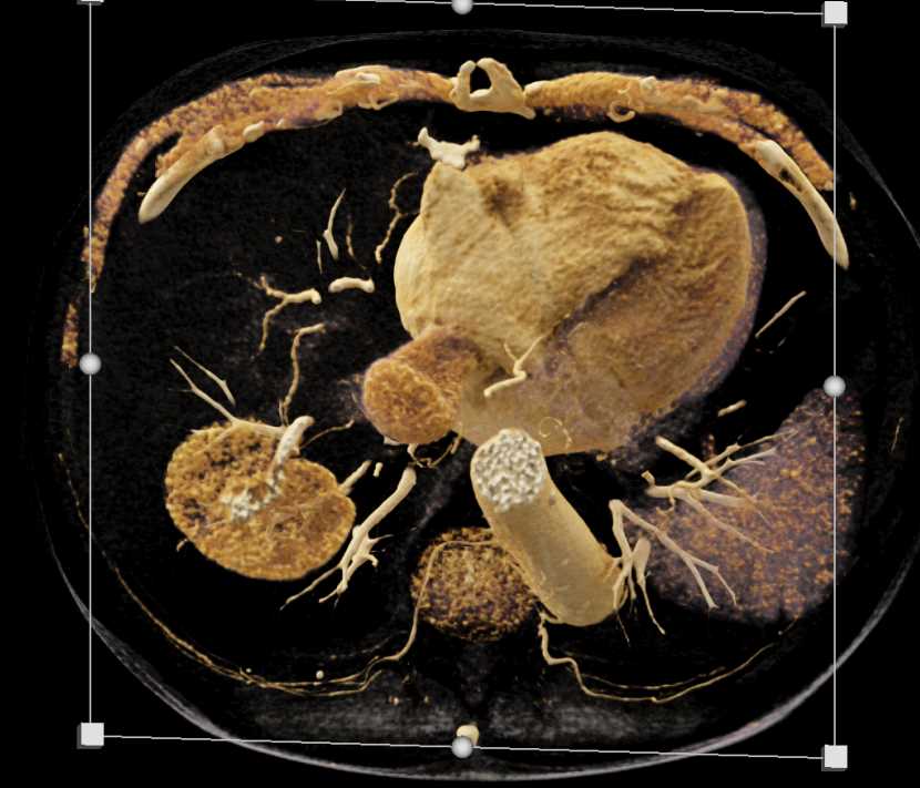 Transitional Cell Carcinoma with AV Shunting - CTisus CT Scan