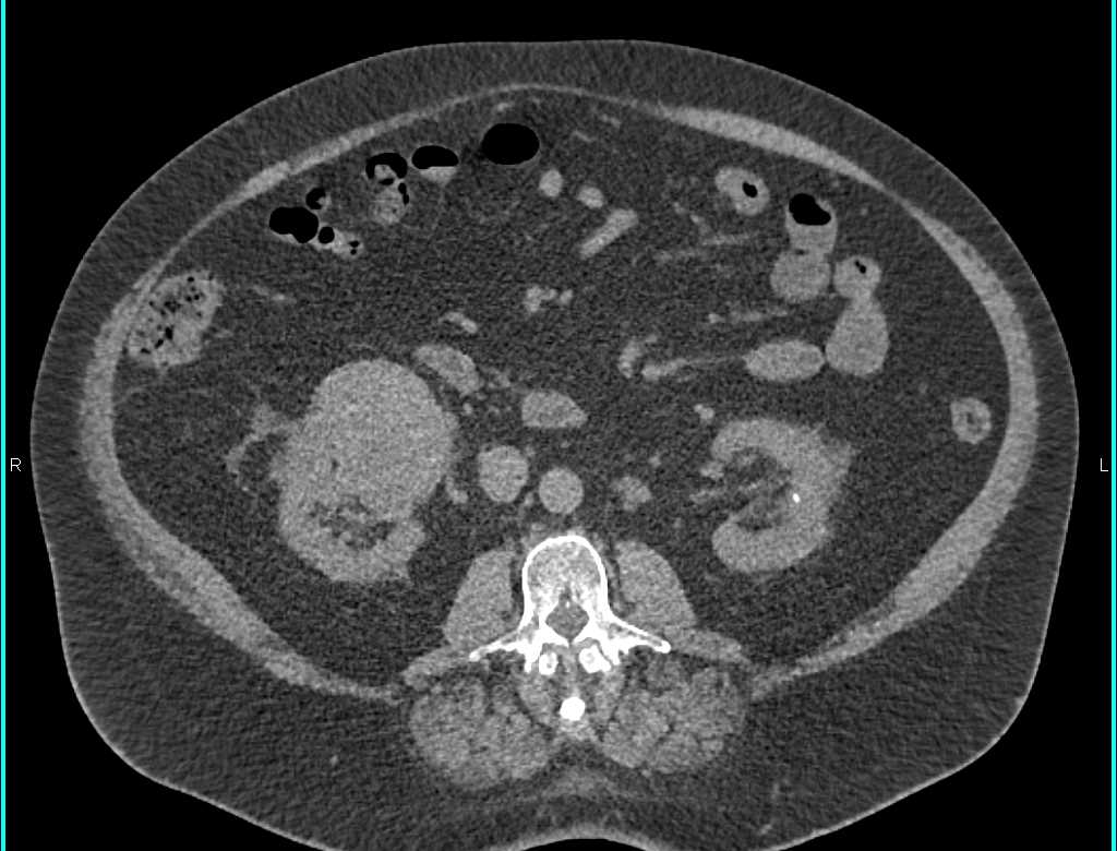 Papillary Renal Cell Carcinoma Right Kidney - CTisus CT Scan