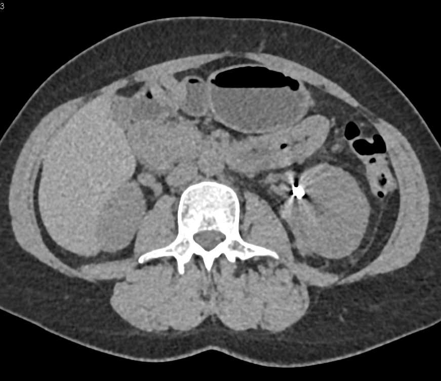 Embolization of a Left Renal Angiomyolipoma (AML) - CTisus CT Scan