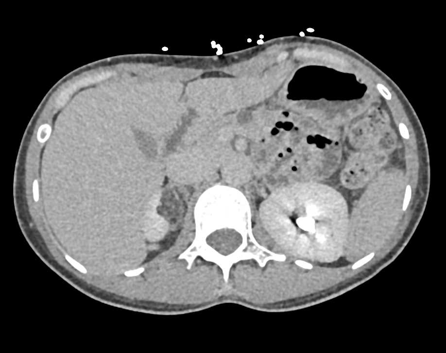 Angiomyolipoma Upper Pole Right Kidney - CTisus CT Scan