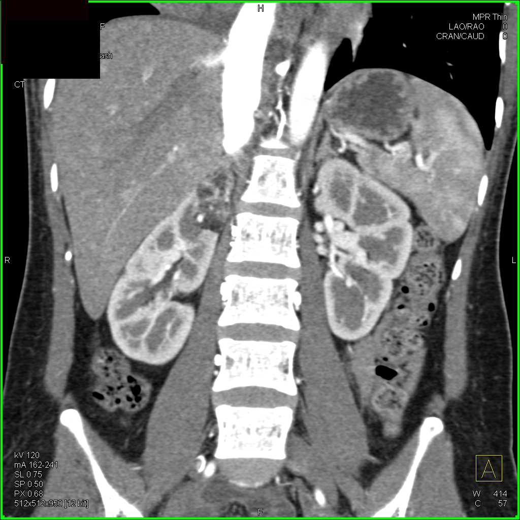 Angiomyolipoma Upper Pole Right Kidney - CTisus CT Scan