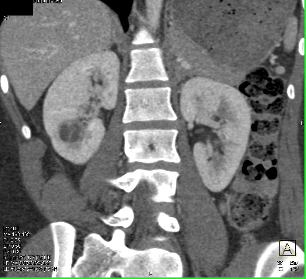 Abscess Lower Pole Right Kidney - CTisus CT Scan