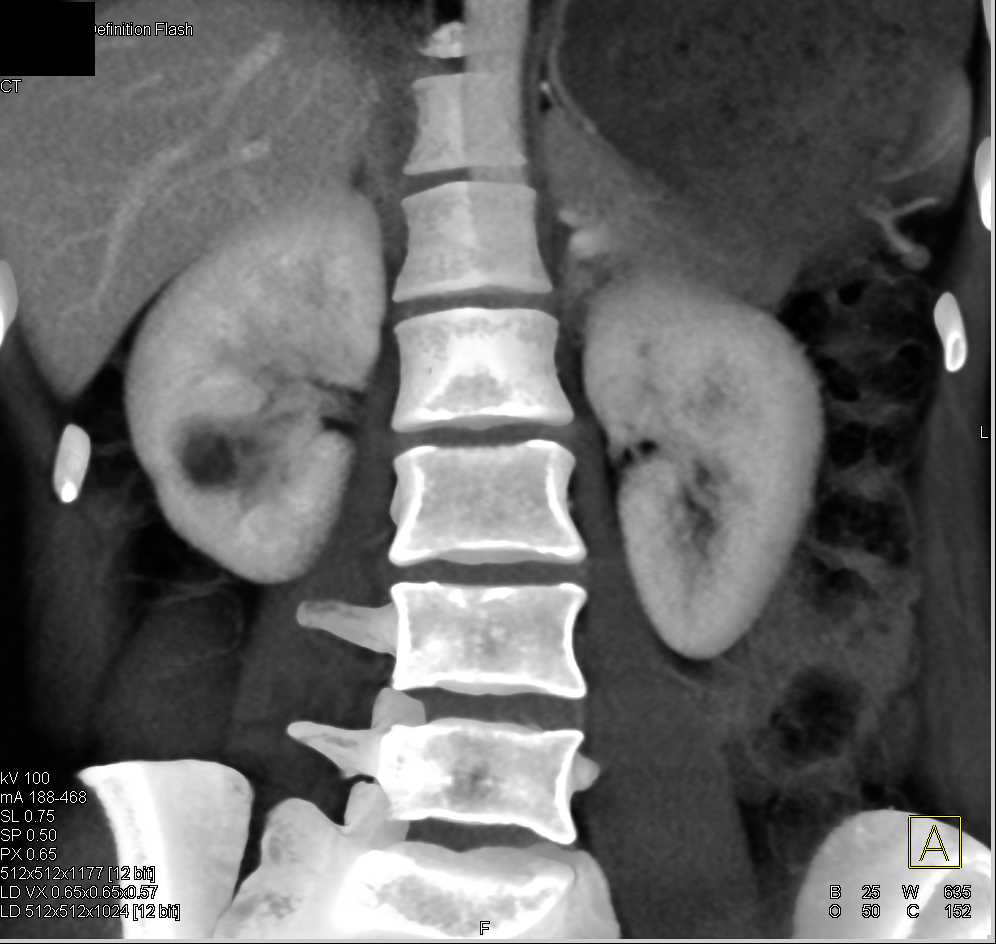 Abscess Lower Pole Right Kidney - CTisus CT Scan