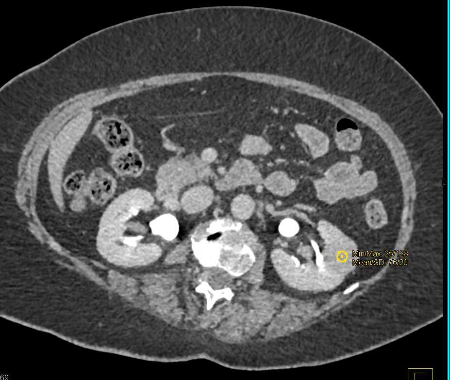High Density Cyst Left Kidney - CTisus CT Scan