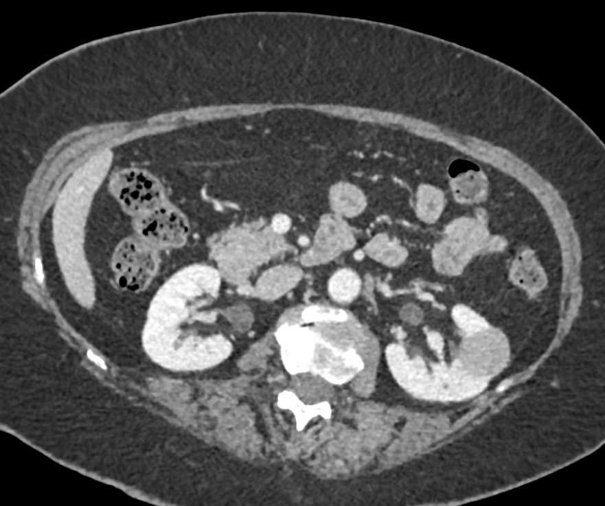 High Density Cyst Left Kidney - CTisus CT Scan