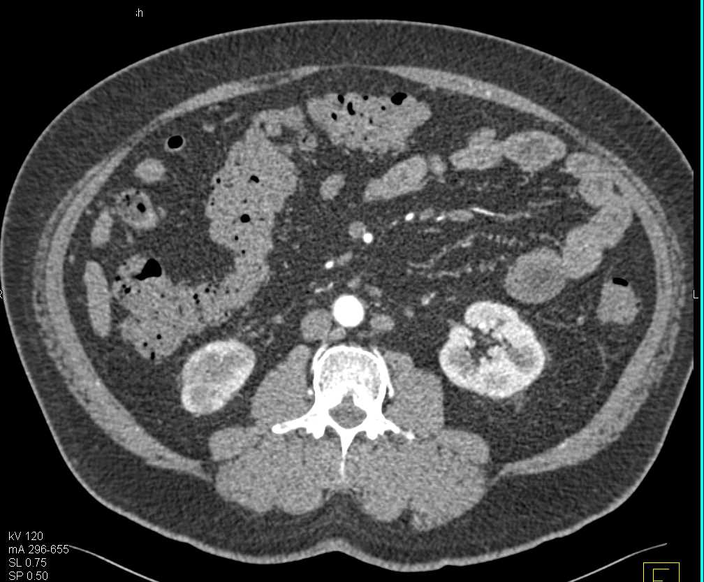 Acute Pyelonephritis Lower Pole of the Right Kidney - CTisus CT Scan