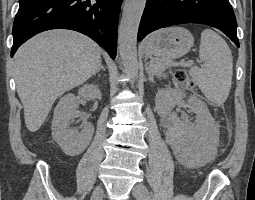 Clear Cell Left Renal Cell Carcinoma with Renal Vein Involvement - CTisus CT Scan