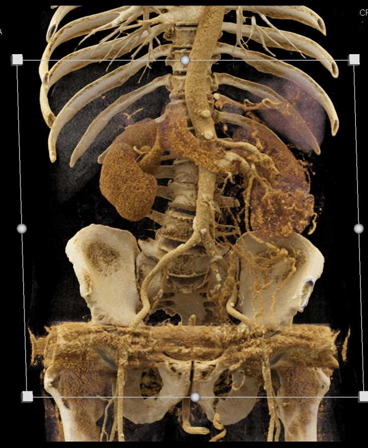 Clear Cell Left Renal Cell Carcinoma with Renal Vein Involvement - CTisus CT Scan