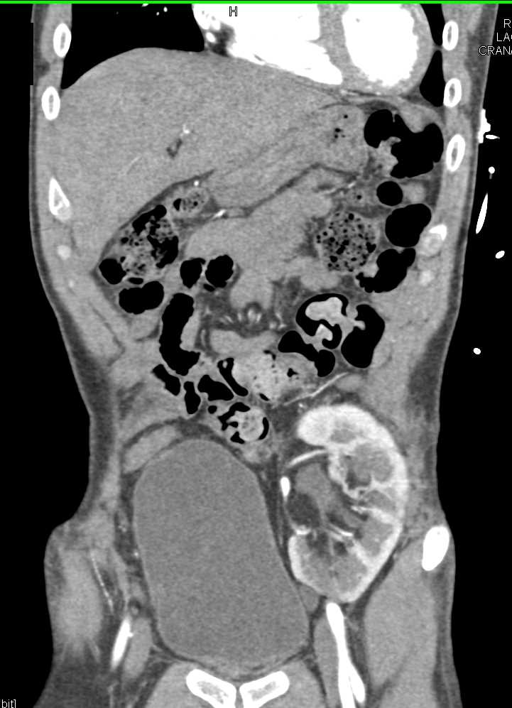 Transplant Kidney in the Left Lower Quadrant - CTisus CT Scan