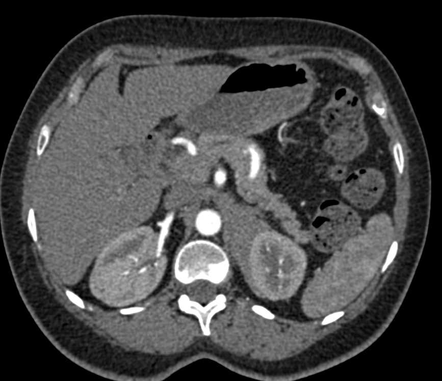 Perirenal Lymphoma Upper Pole Left Kidney - CTisus CT Scan