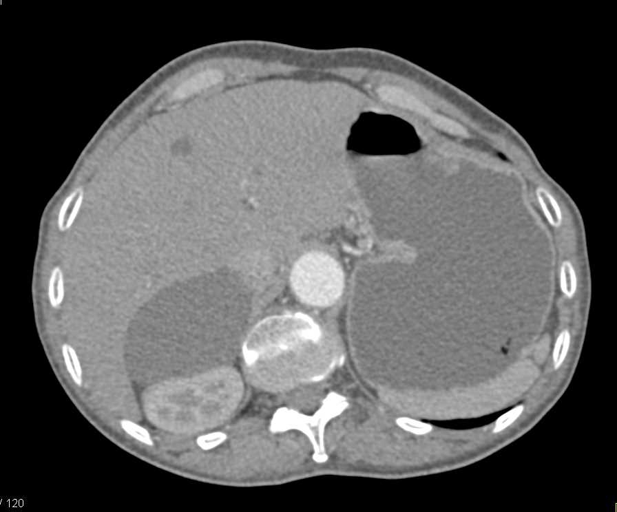 Renal Cyst - CTisus CT Scan