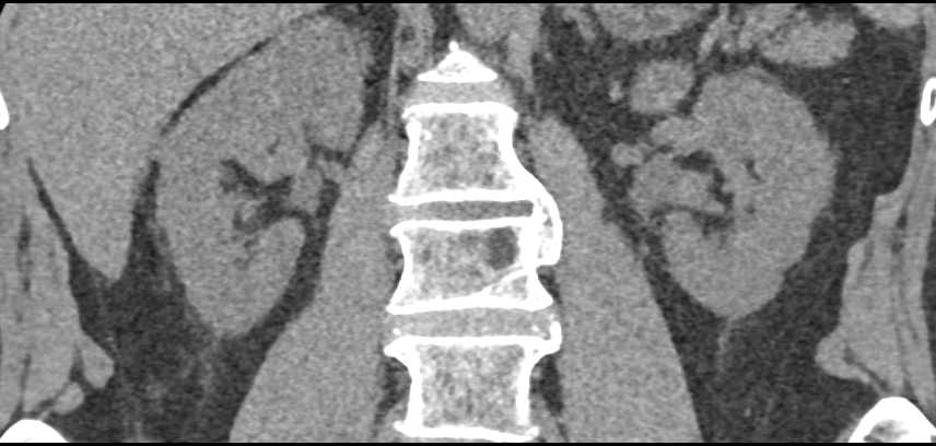 Transitional Cell Carcinoma Left Kidney - CTisus CT Scan