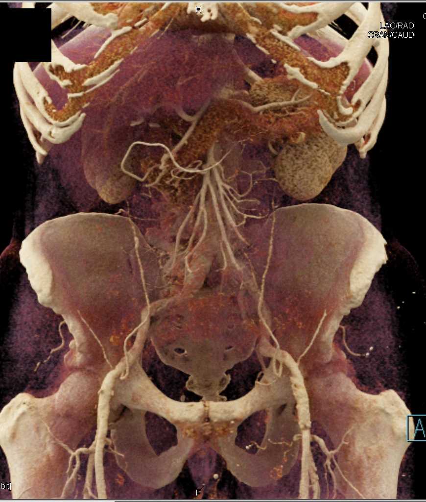 Transitional Cell Carcinoma Left Kidney with Cinematic Rendering - CTisus CT Scan