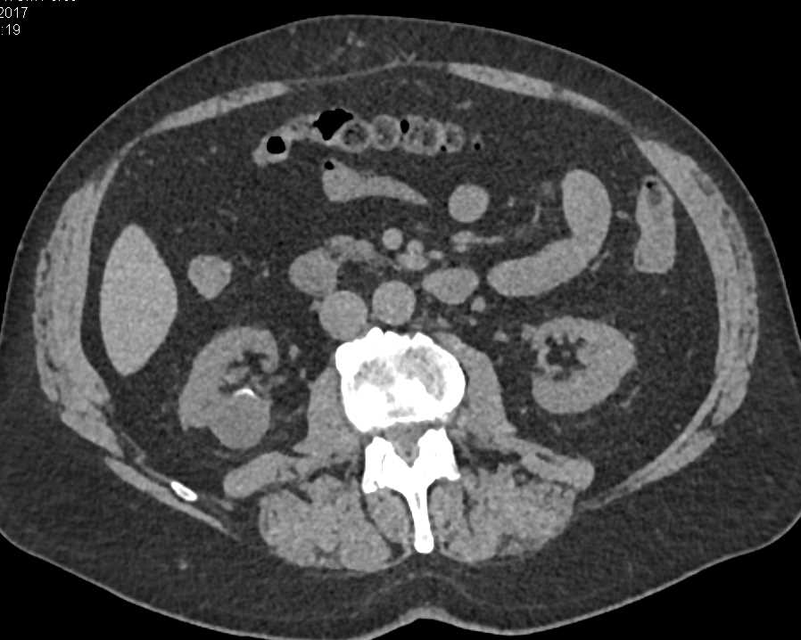 Cystic Papillary Right Renal Cell Carcinoma - CTisus CT Scan