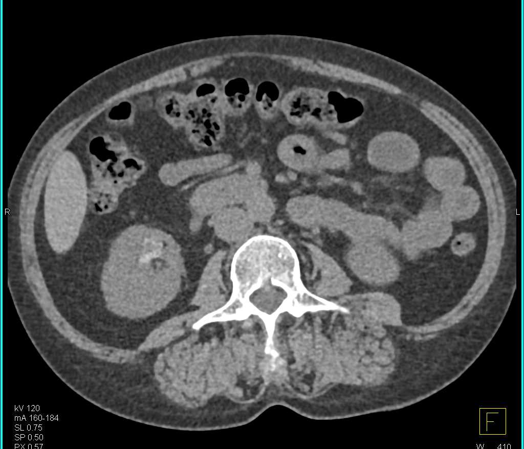 Transitional Cell Carcinoma Right Kidney - CTisus CT Scan