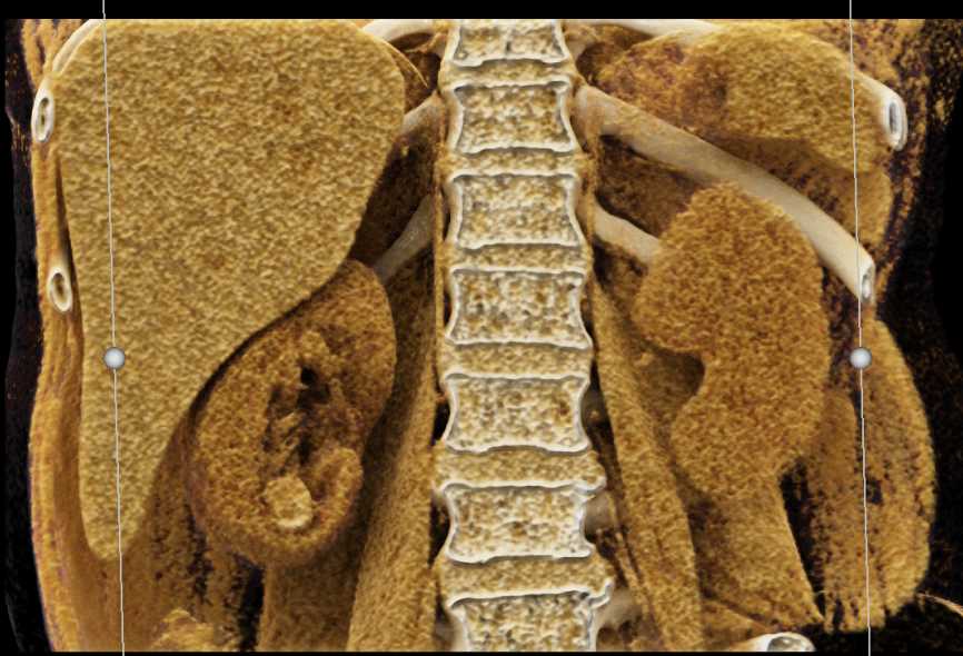 Transitional Cell Carcinoma Right Kidney - CTisus CT Scan