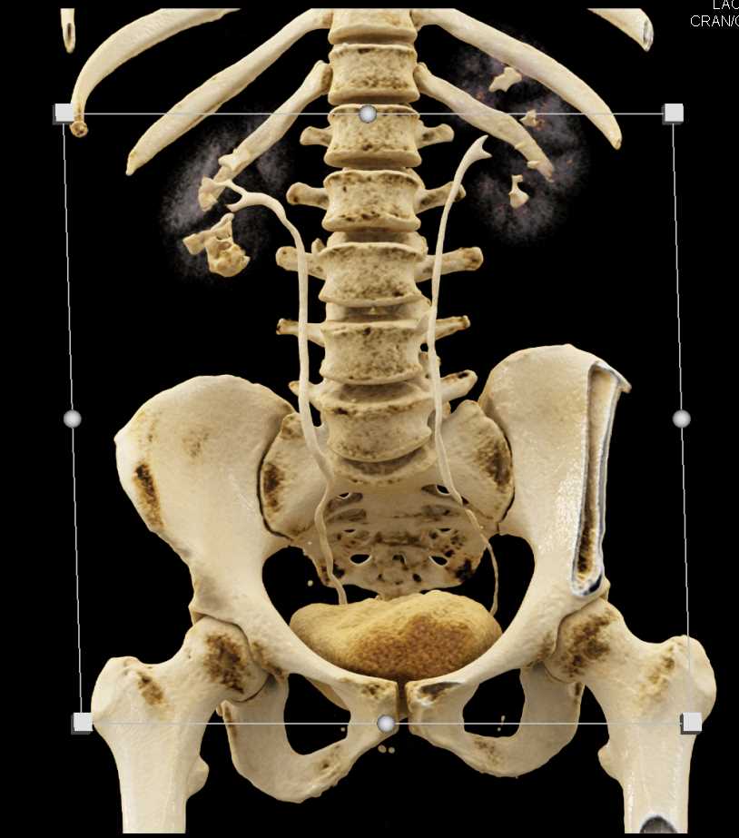 Transitional Cell Carcinoma Right Kidney - CTisus CT Scan