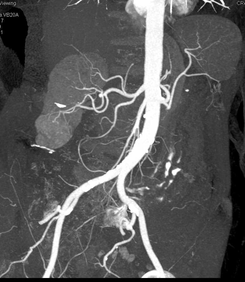 Clear Cell Renal Cell Carcinoma Right Kidney - CTisus CT Scan