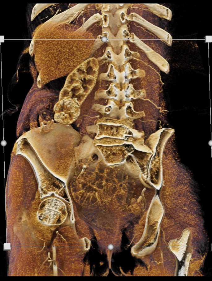 Clear Cell Renal Cell Carcinoma Right Kidney - CTisus CT Scan