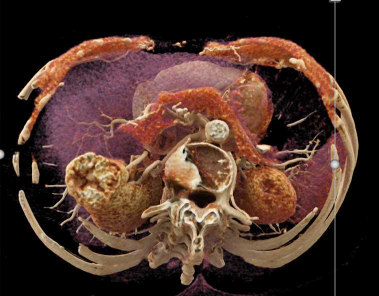 Clear Cell Renal Cell Carcinoma Right Kidney - CTisus CT Scan