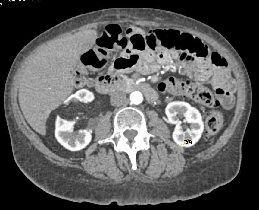 Angiomyolipoma Right Kidney - CTisus CT Scan