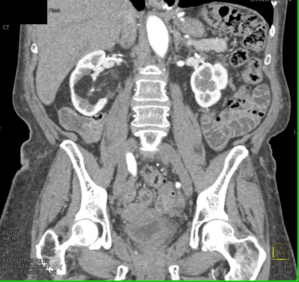 Angiomyolipoma Right Kidney - CTisus CT Scan