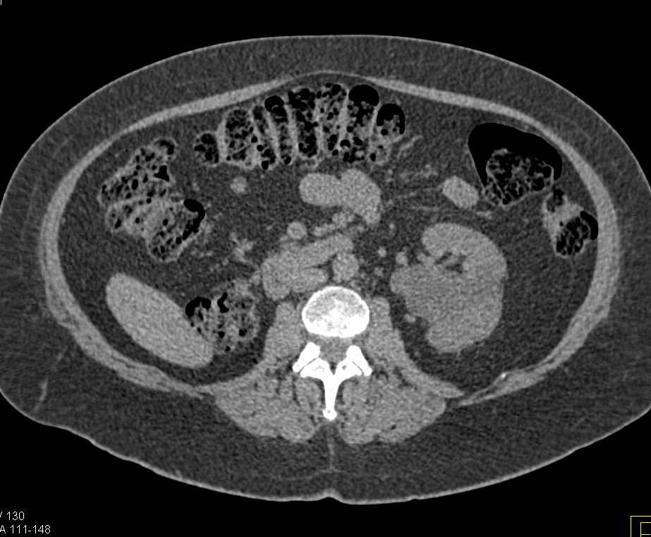 Post Right Nephrectomy Changes - CTisus CT Scan