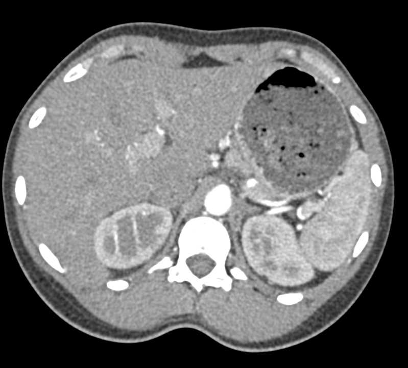 Acute Pyelonephritis - CTisus CT Scan