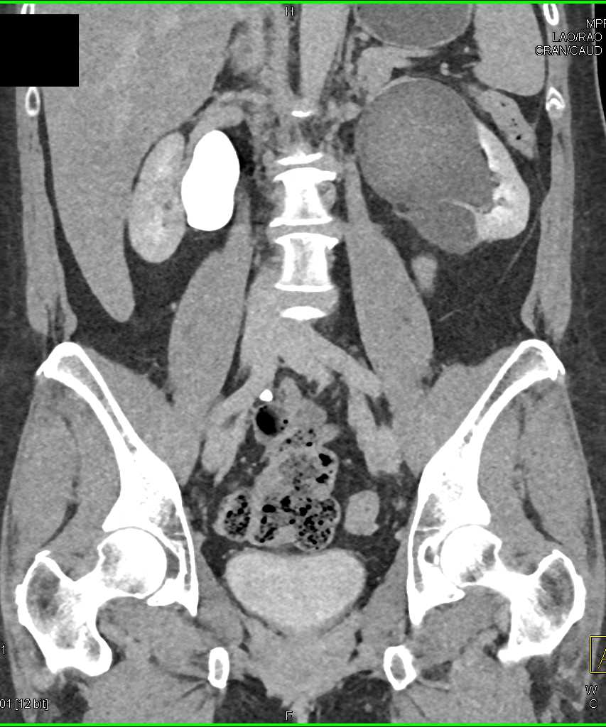 Ureteropelvic Junction (UPJ) Left Renal Pelvis - CTisus CT Scan