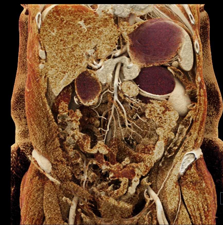 Ureteropelvic Junction (UPJ) Left Renal Pelvis due to Accessory Left Renal Artery - CTisus CT Scan